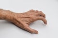 VolkmannÃ¢â¬â¢s contracture in Southeast Asian old man